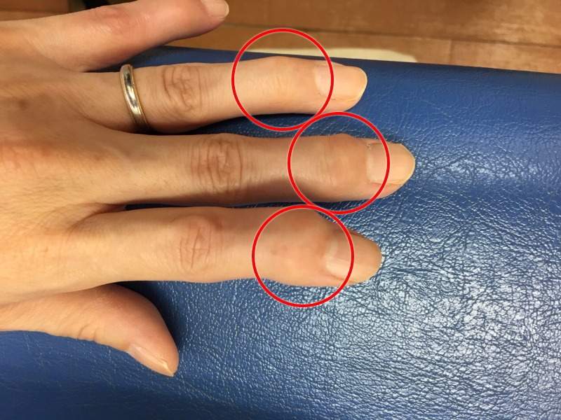 ヘバーデン結節・指先の第一関節の痛み